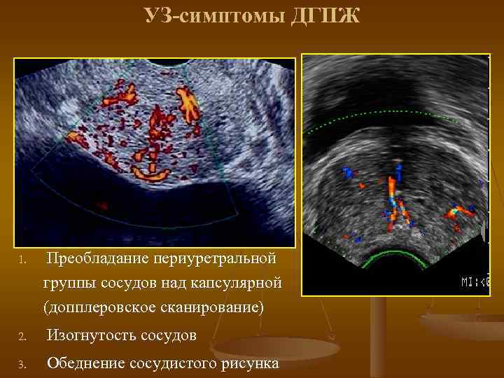 УЗ-симптомы ДГПЖ 1. Преобладание периуретральной группы сосудов над капсулярной (допплеровское сканирование) 2. Изогнутость сосудов