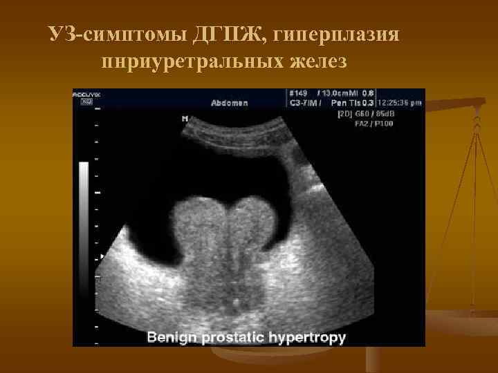 УЗ-симптомы ДГПЖ, гиперплазия пнриуретральных желез 