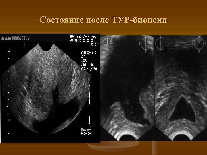 Состояние после ТУР-биопсии 