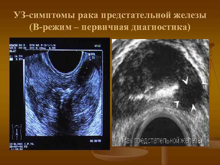 УЗ-симптомы рака предстательной железы (В-режим – первичная диагностика) 