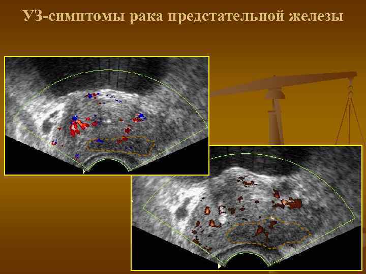 УЗ-симптомы рака предстательной железы 