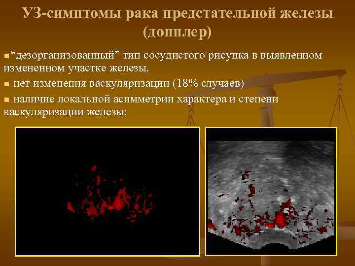 УЗ-симптомы рака предстательной железы (допплер) n “дезорганизованный” тип сосудистого рисунка в выявленном измененном участке