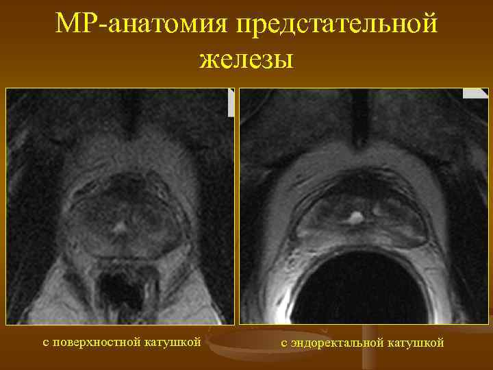 МР-анатомия предстательной железы с поверхностной катушкой с эндоректальной катушкой 