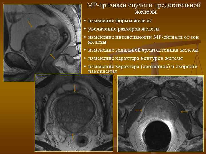 МР-признаки опухоли предстательной железы • изменение формы железы • увеличение размеров железы • изменение