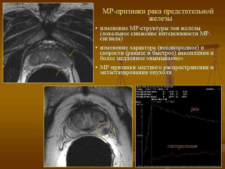 МР-признаки рака предстательной железы • изменение МР-структуры зон железы (локальное снижение интенсивности МРсигнала) •