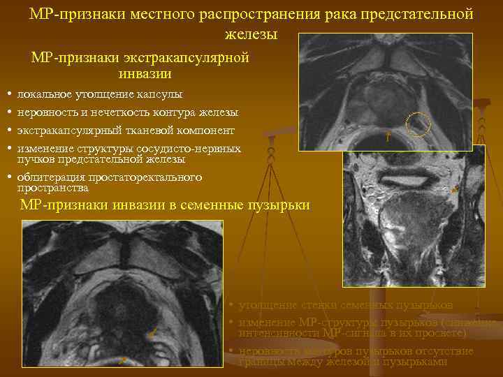 МР-признаки местного распространения рака предстательной железы МР-признаки экстракапсулярной инвазии • • локальное утолщение капсулы