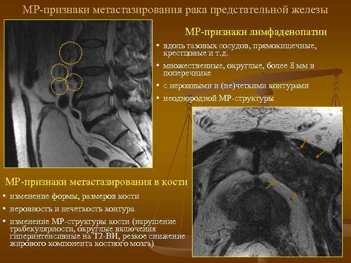 МР-признаки метастазирования рака предстательной железы МР-признаки лимфаденопатии • вдоль тазовых сосудов, прямокишечные, крестцовые и