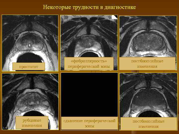 Некоторые трудности в диагностике простатит рубцовые изменения «фибриллярность» периферической зоны сдавление периферической зоны постбиопсийные