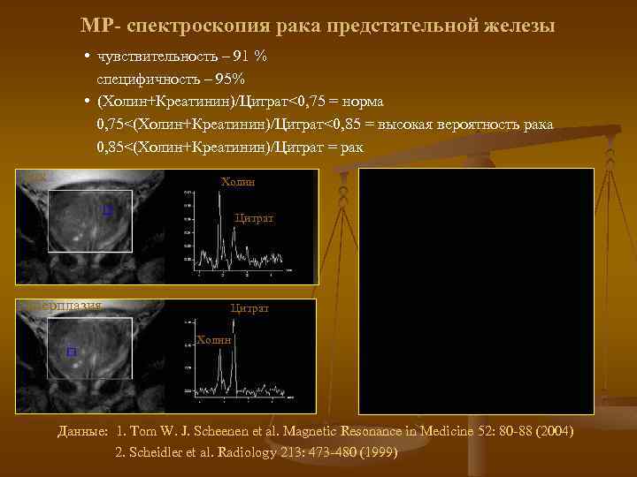 МР- спектроскопия рака предстательной железы • чувствительность – 91 % специфичность – 95% •