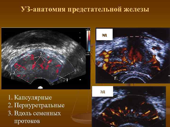 УЗ-анатомия предстательной железы эд 1. Капсулярные 2. Периуретральные 3. Вдоль семенных протоков эд 