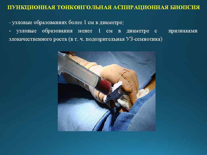 ПУНКЦИОННАЯ ТОНКОИГОЛЬНАЯ АСПИРАЦИОННАЯ БИОПСИЯ - узловые образованиях более 1 см в диаметре; - узловые