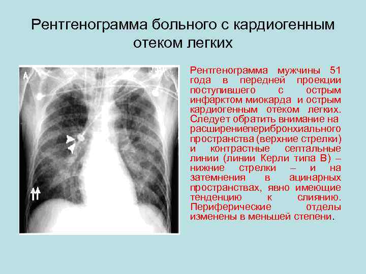 Отек легких рентгенологическая картина