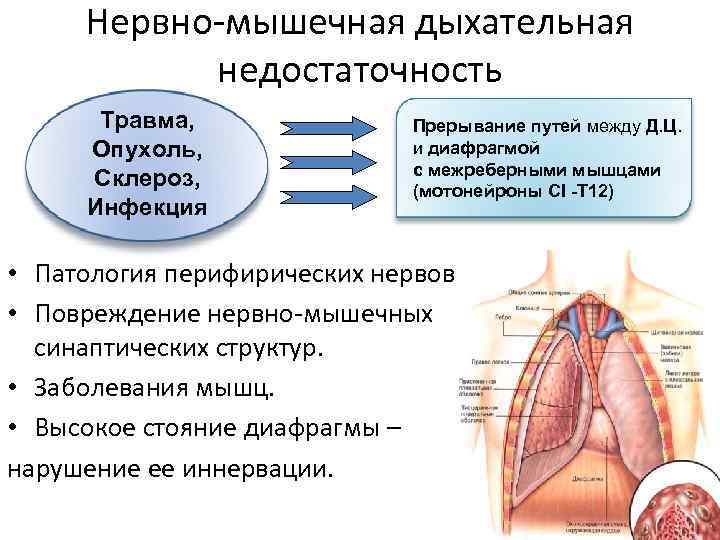 Нервно-мышечная дыхательная недостаточность Травма, Опухоль, Склероз, Инфекция Прерывание путей между Д. Ц. и диафрагмой