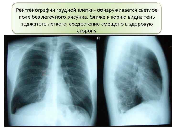 Рентгенография грудной клетки- обнаруживается светлое поле без легочного рисунка, ближе к корню видна тень