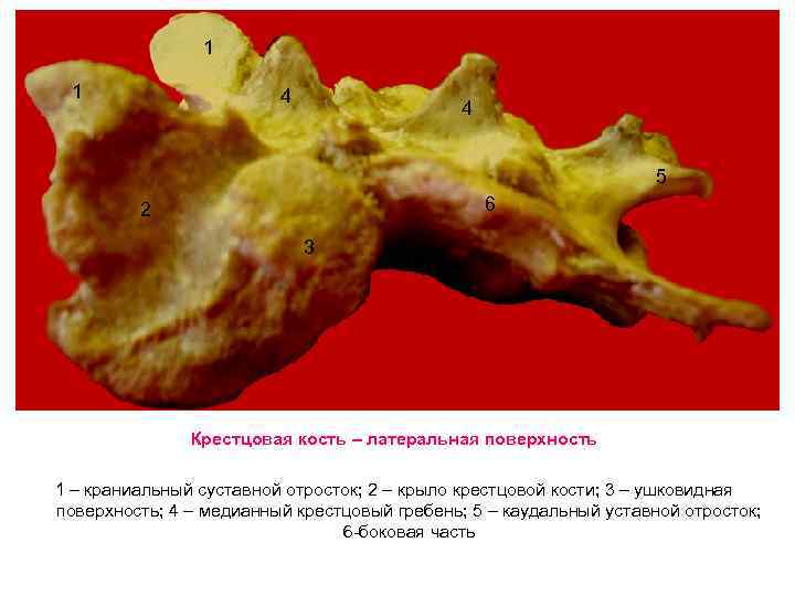 1 1 4 4 5 6 2 3 Крестцовая кость – латеральная поверхность 1