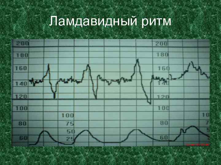 Ламдавидный ритм 