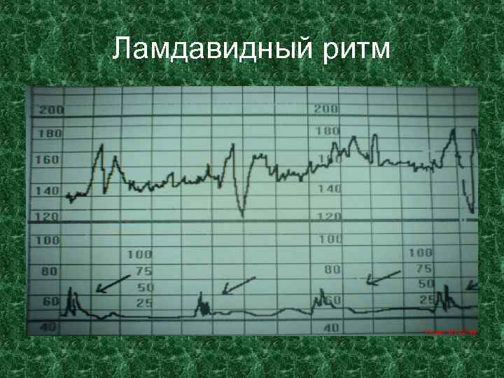 Ламдавидный ритм 