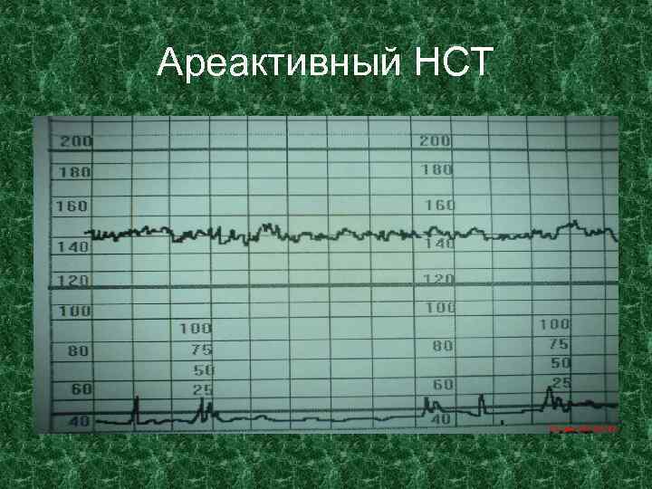 Ареактивный НСТ 