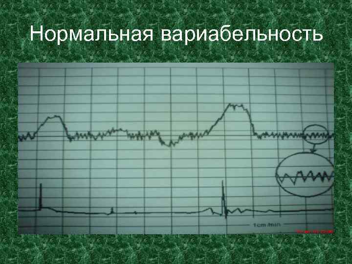 Нормальная вариабельность 