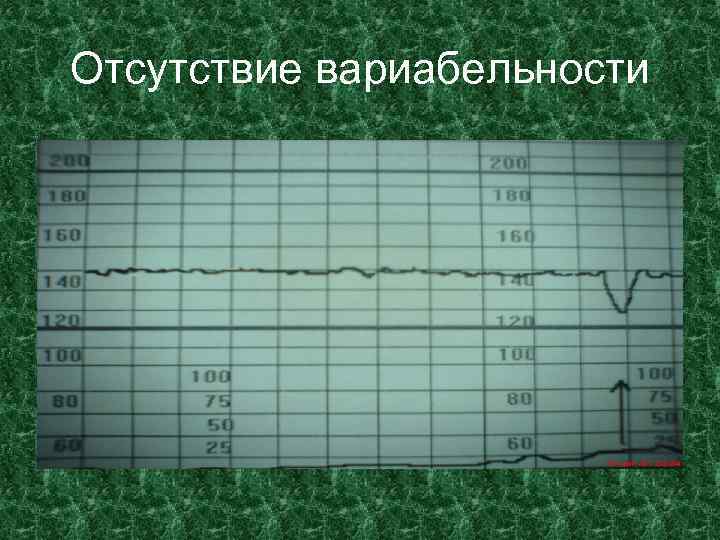 Отсутствие вариабельности • 
