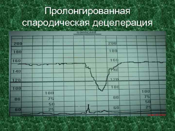 Пролонгированная спародическая децелерация 