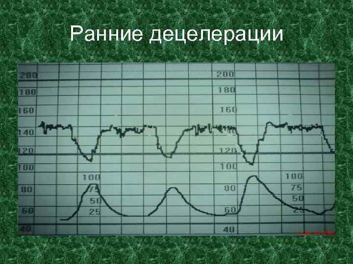 Ранние децелерации 