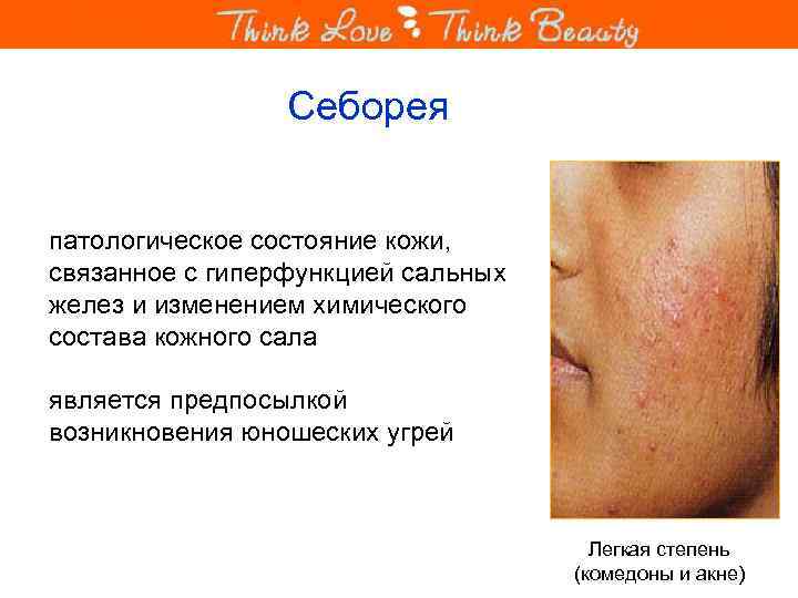 Себорея патологическое состояние кожи, связанное с гиперфункцией сальных желез и изменением химического состава кожного