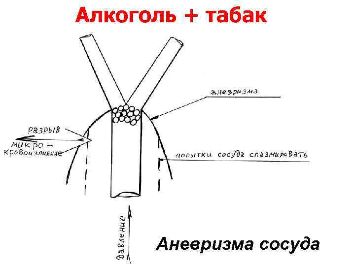 Алкоголь + табак Аневризма сосуда 