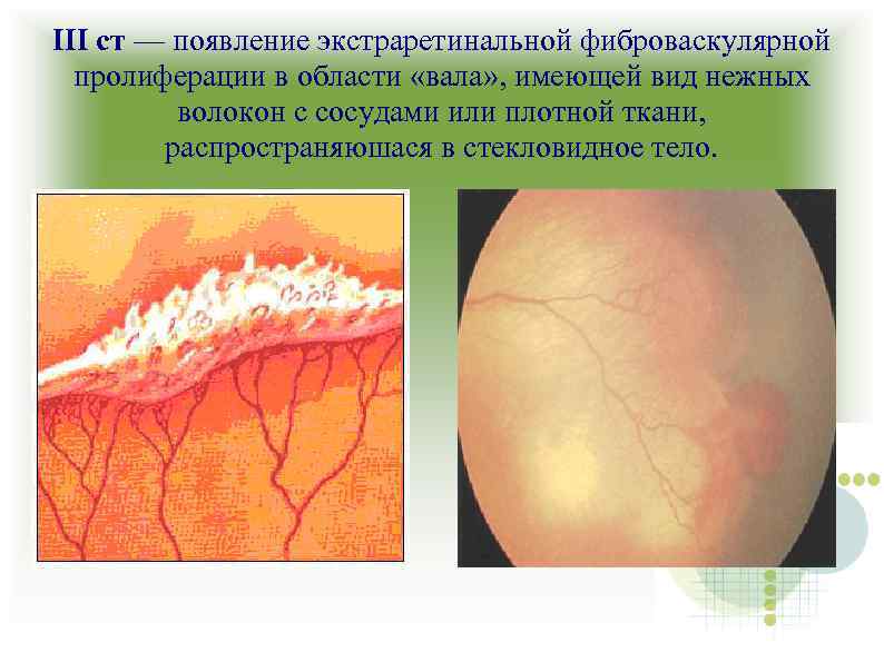 III ст — появление экстраретинальной фиброваскулярной пролиферации в области «вала» , имеющей вид нежных