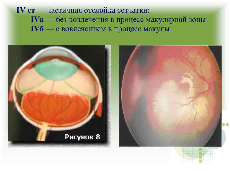 IV ст — частичная отслойка сетчатки: IVа — без вовлечения в процесс макулярной зоны