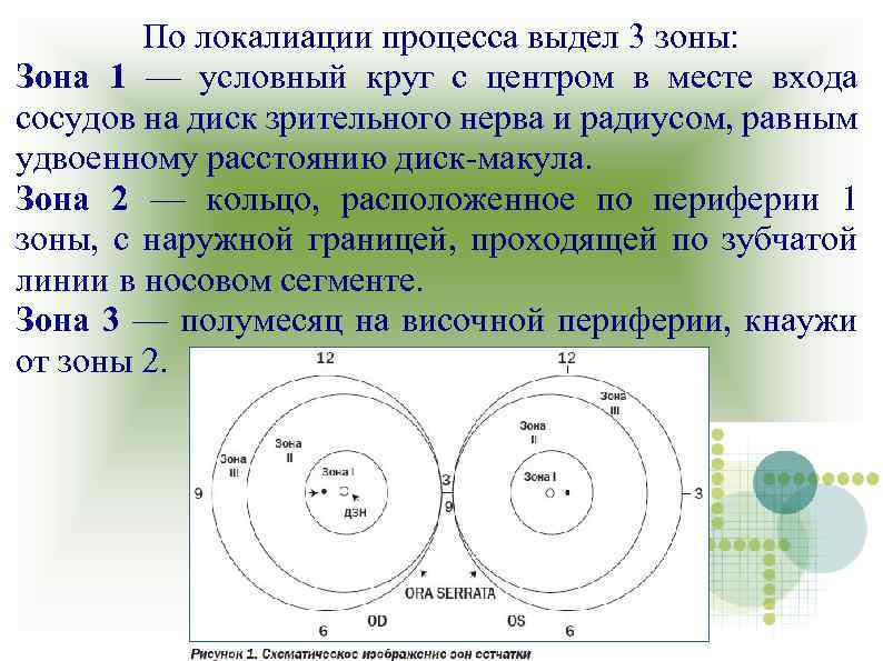 По локалиации процесса выдел 3 зоны: Зона 1 — условный круг с центром в