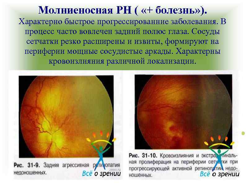 Молниеносная РН ( «+ болезнь» ). Характерно быстрое прогрессированние заболевания. В процесс часто вовлечен