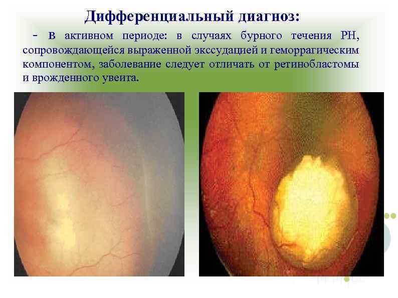 Дифференциальный диагноз: - в активном периоде: в случаях бурного течения РН, сопровождающейся выраженной экссудацией