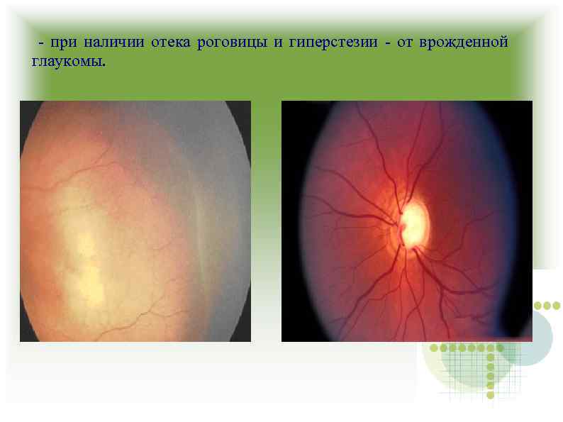 - при наличии отека роговицы и гиперстезии - от врожденной глаукомы. 