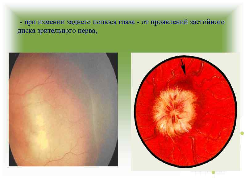 - при измении заднего полюса глаза - от проявлений застойного диска зрительного нерва, 
