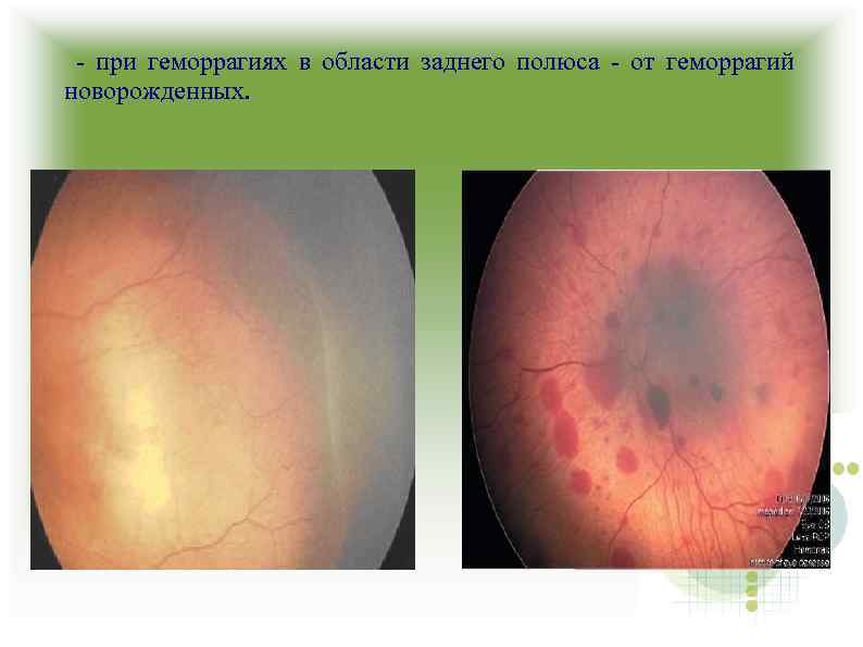 - при геморрагиях в области заднего полюса - от геморрагий новорожденных. 