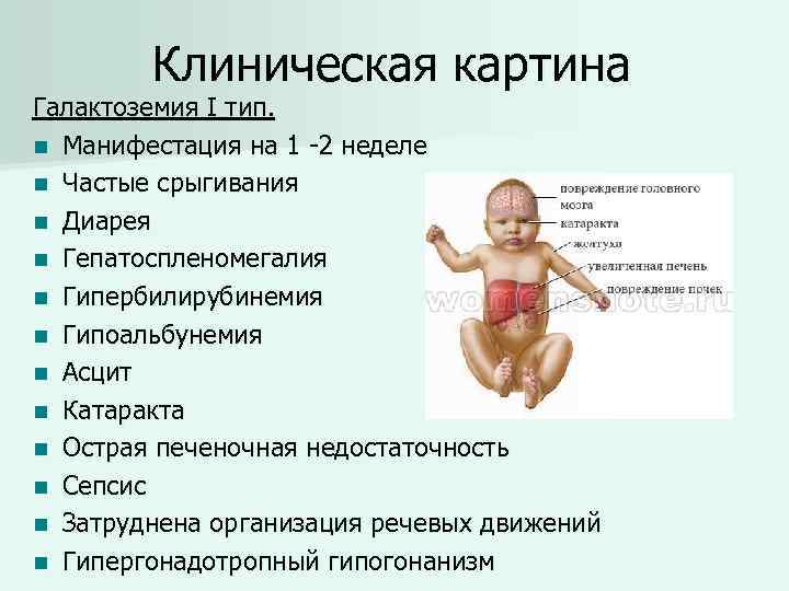 Гипотония у новорожденного