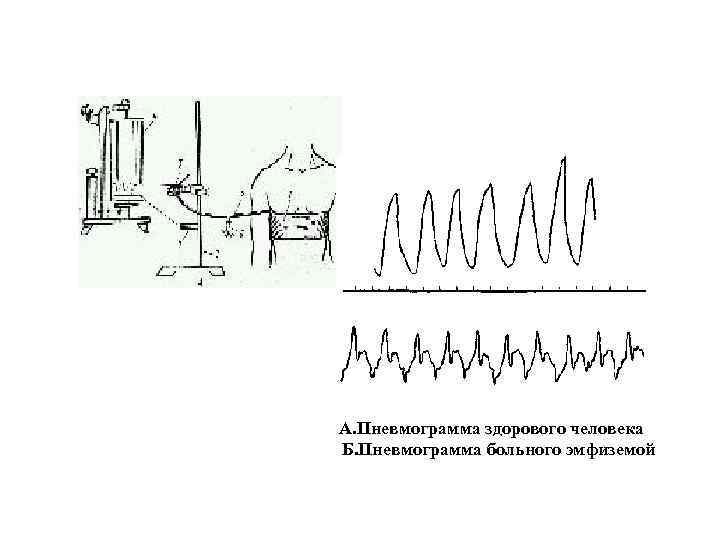 А. Пневмограмма здорового человека Б. Пневмограмма больного эмфиземой 