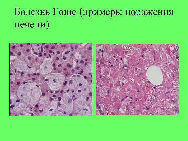 Болезнь гоше. Селезенка при болезни Гоше патанатомия. Селезенка при болезни Гоше микропрепарат. Болезнь Гоше микропрепарат. Болезнь Гоше микропрепарат селезенки.