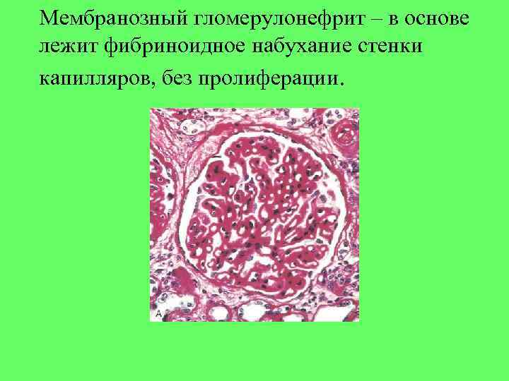 Мембранозный гломерулонефрит – в основе лежит фибриноидное набухание стенки капилляров, без пролиферации. 