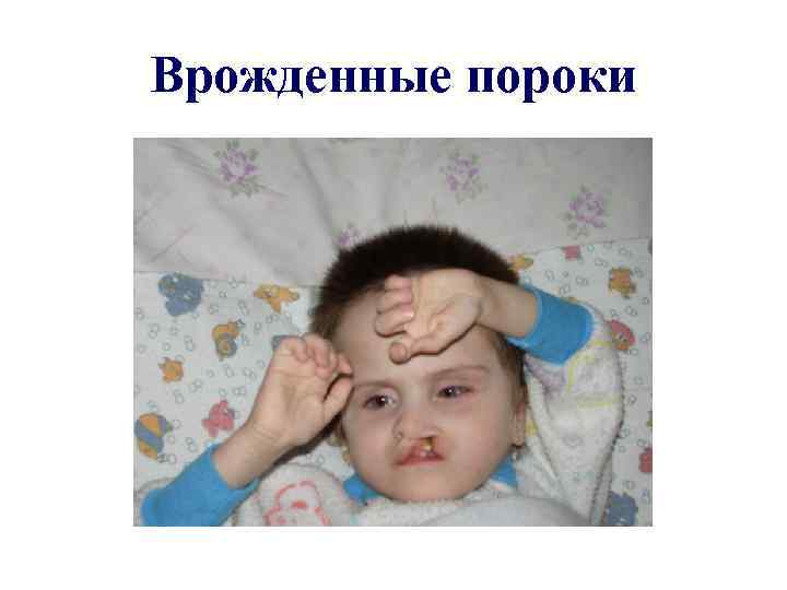 Врожденные пороки 