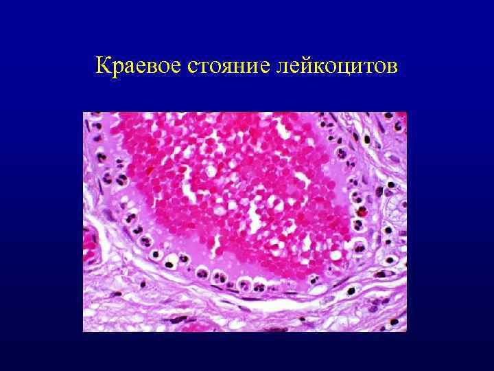 Краевое стояние лейкоцитов 