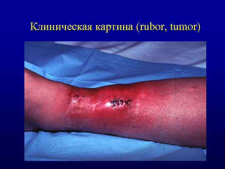 Клиническая картина (rubor, tumor) 