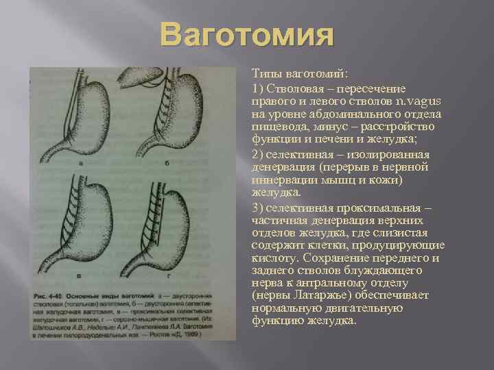 Ваготомия Типы ваготомий: 1) Стволовая – пересечение правого и левого стволов n. vagus на