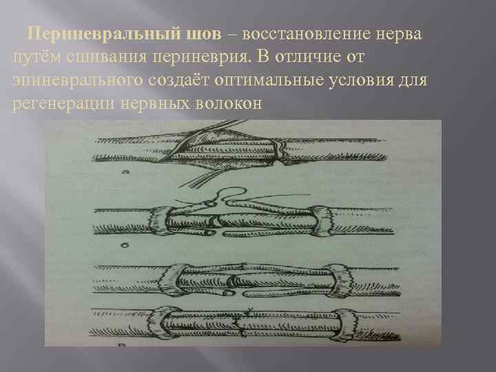 Периневральный шов – восстановление нерва путём сшивания периневрия. В отличие от эпиневрального создаёт оптимальные