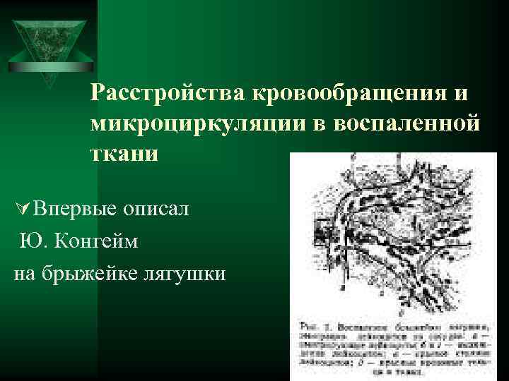  Расстройства кровообращения и микроциркуляции в воспаленной ткани Ú Впервые описал Ю. Конгейм на