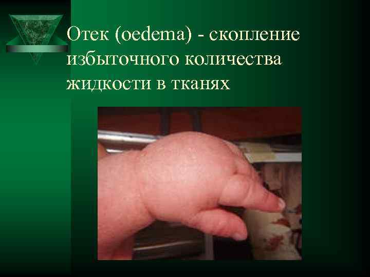 Отек (oedema) - скопление избыточного количества жидкости в тканях 