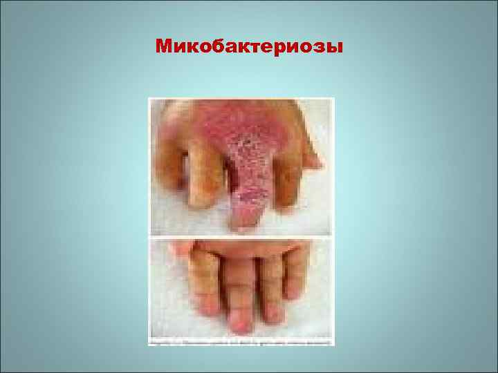 Микобактериозы 
