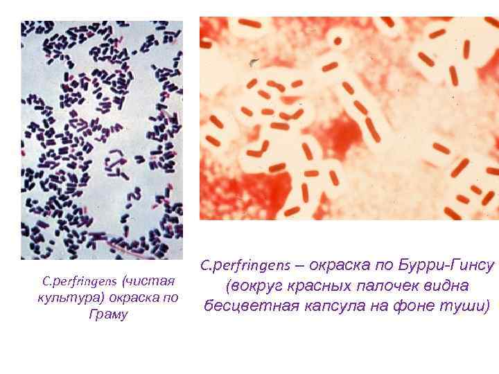 C. рerfringens (чистая культура) окраска по Граму C. рerfringens – окраска по Бурри-Гинсу (вокруг