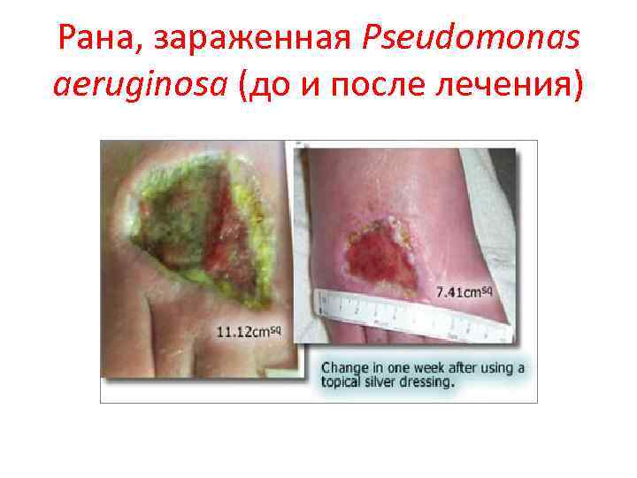 Рана, зараженная Pseudomonas aeruginosa (до и после лечения) 